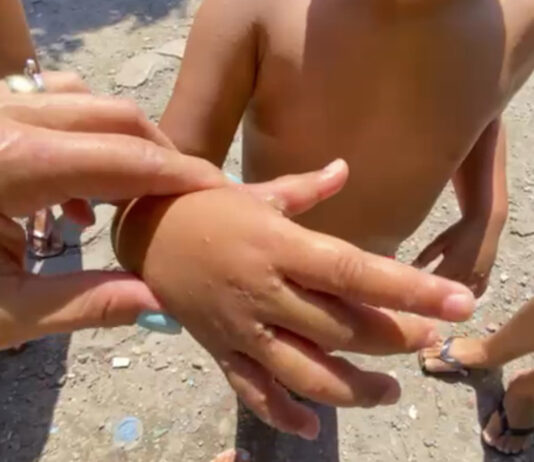 Em meio à pandemia de Covid-19, comunidades da Praia Grande relatam surto de sarna humana